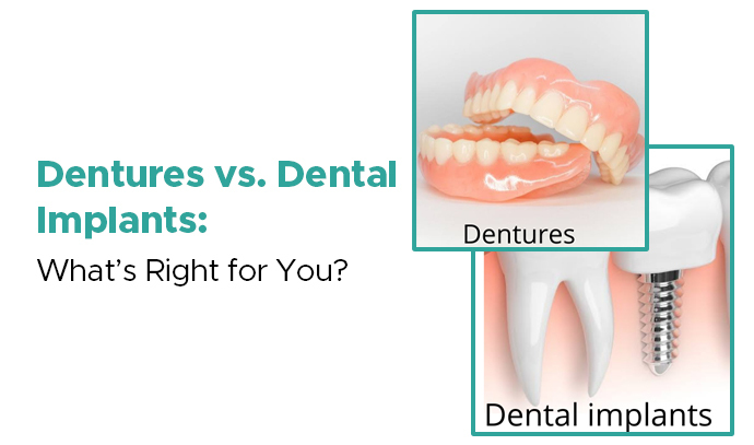 Dentures vs. Dental Implants: What’s Right for You