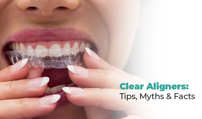 Clear Aligners: Tips, Myths & Facts