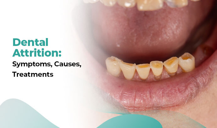Dental Attrition: Symptoms, Causes, Treatments