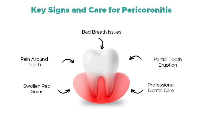 elite dental pericoronitis