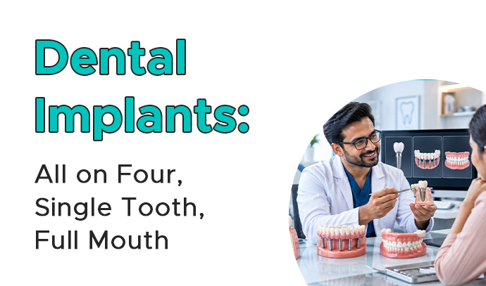 dental implants- all on four, single tooth, full mouth